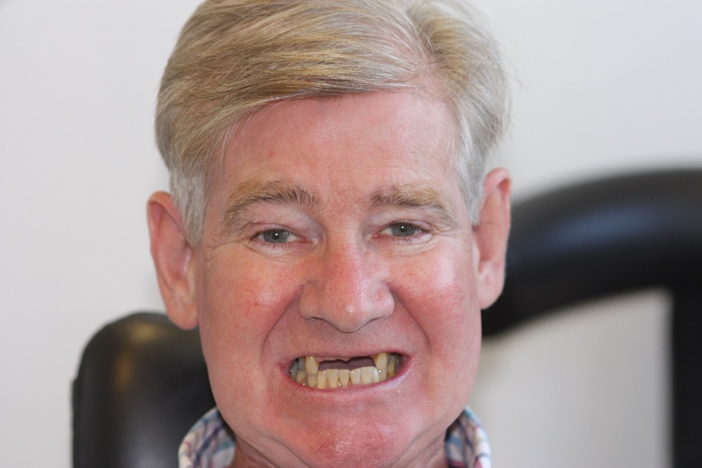 dental implants in Preston