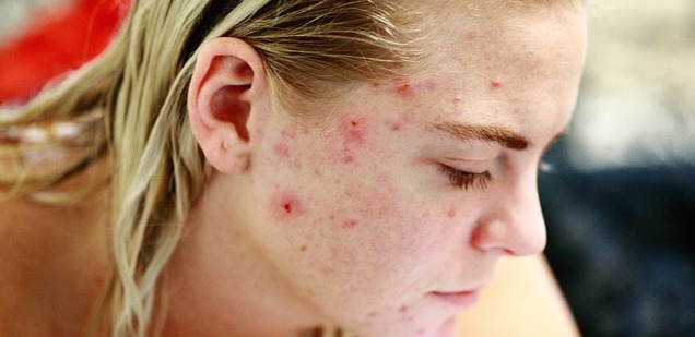 acne scars dermal fillers